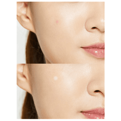 Acné Pimple Master Patch 15 uds